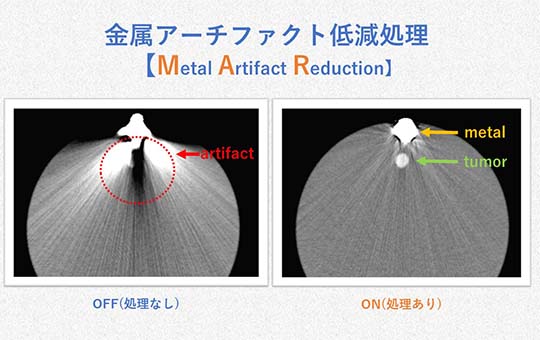 画像(金属アーチファクト低減処理に関する研究)_RT轟